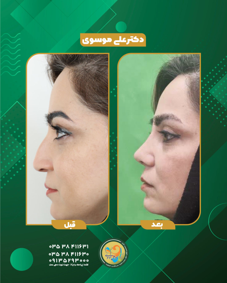 رینو پلاستی 