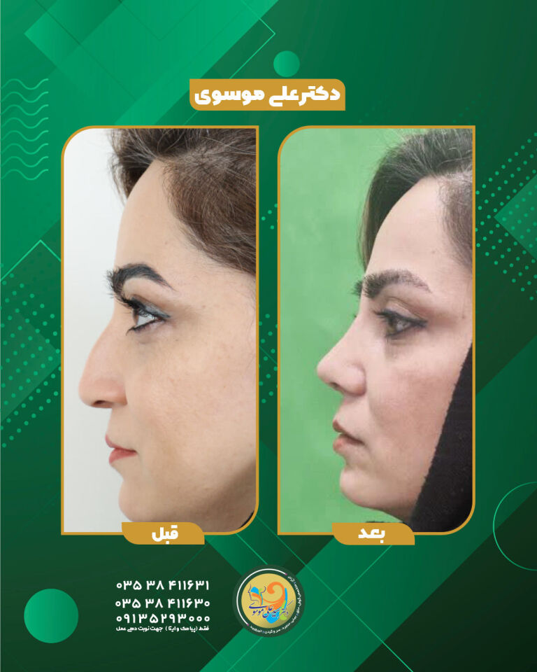 رینو پلاستی 